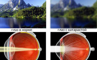 Катаракта: симптомы, причины, лечение и профилактика